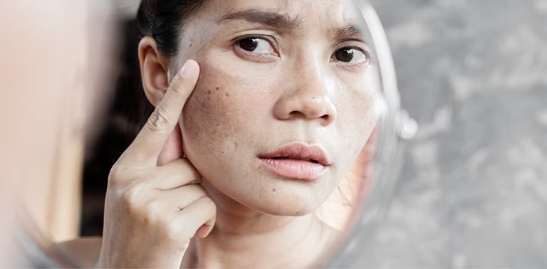 Làn da xuất hiện đồi mồi, một trong những dấu hiệu xuất hiện trong quá trình lão hóa sớm