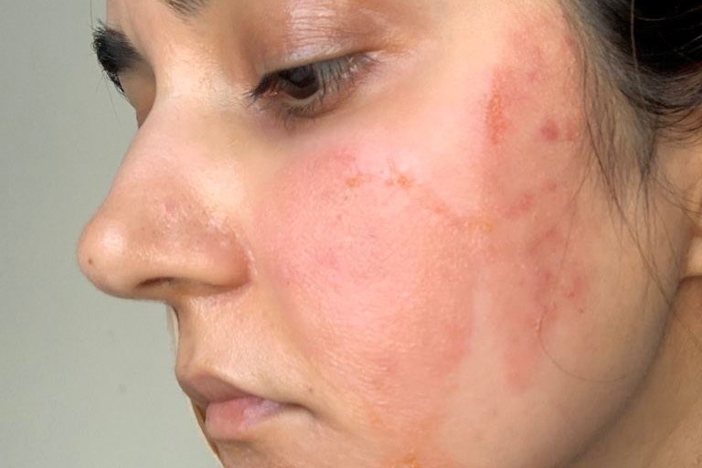 Chăm sóc da treatment sai cách gây burn – bỏng hóa học với biểu hiện đỏ rát và bong tróc da
