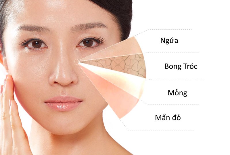 Hình ảnh minh họa các đặc điểm làn da nhạy cảm dễ kích ứng và gây suy yếu hàng rào bảo vệ da