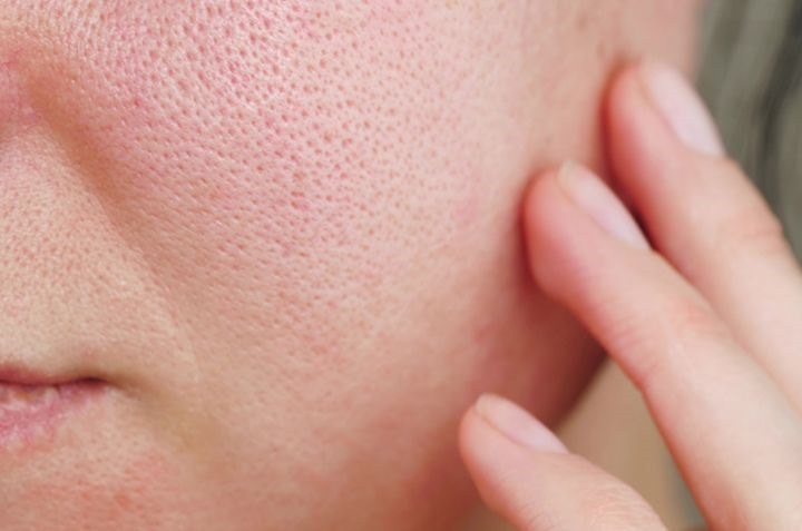 Hình ảnh minh họa về tình trạng da có lỗ chân lông to khiến các nàng tự ti