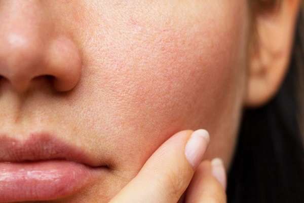 Bề mặt làn da xỉn màu thô ráp, sần sùi do tế bào chết tích tụ