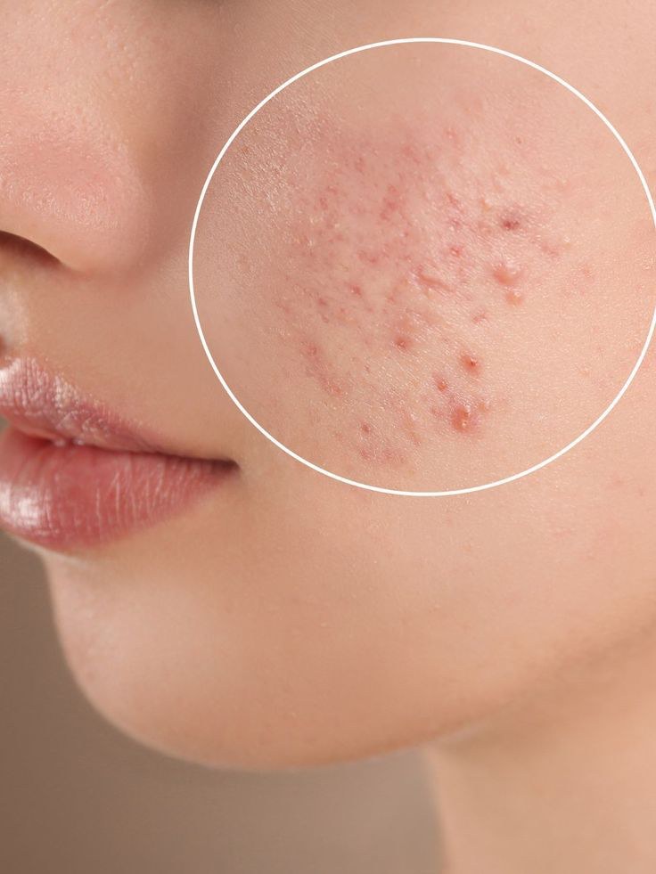 Da xuất hiện đỏ rát, khô căng và bong tróc sau các liệu trình treatment.