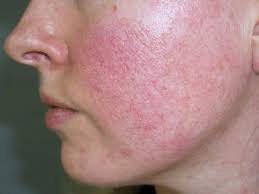 Dấu hiệu da nhiễm corticoid thường gặp: da đỏ kéo dài, mỏng yếu và dễ kích ứng