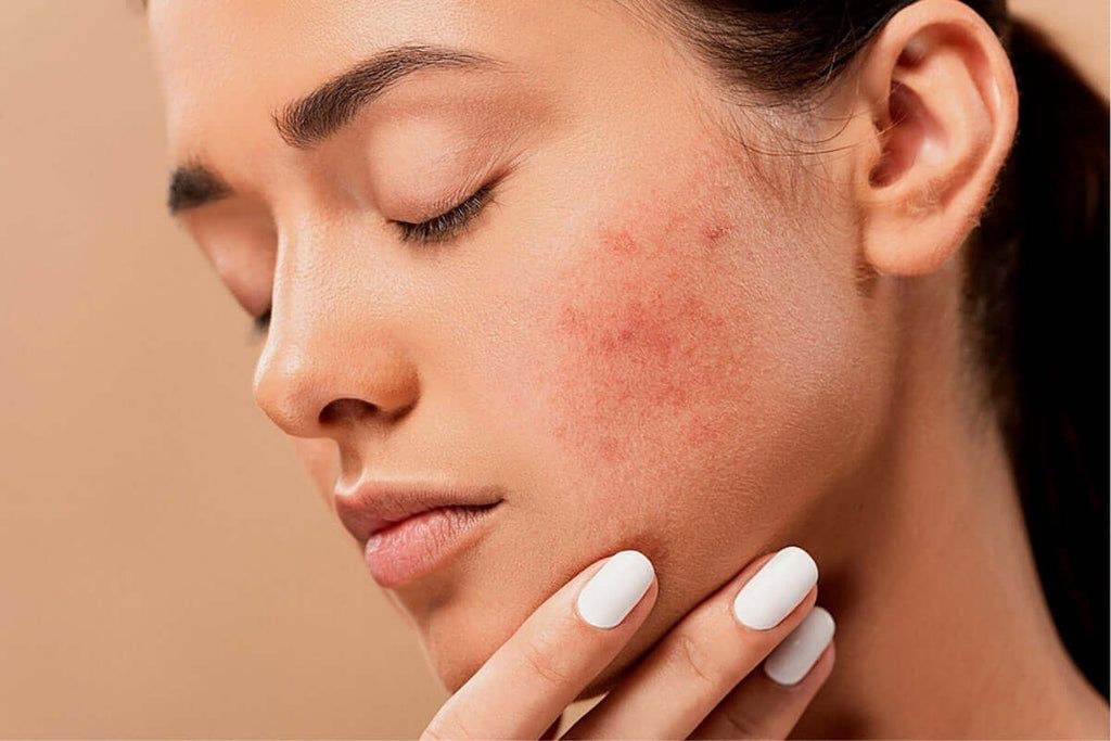 Da nhạy cảm dễ kích ứng, đỏ rát do hàng rào bảo vệ da mỏng và suy yếu