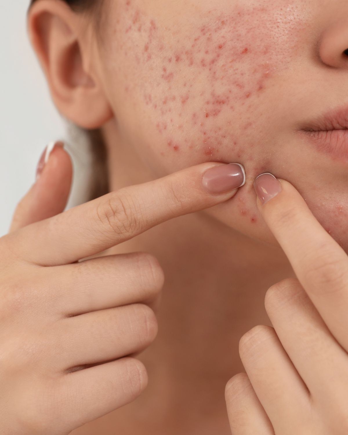Mụn bùng phát do hàng rào bảo vệ da suy yếu và mất cân bằng sinh học
